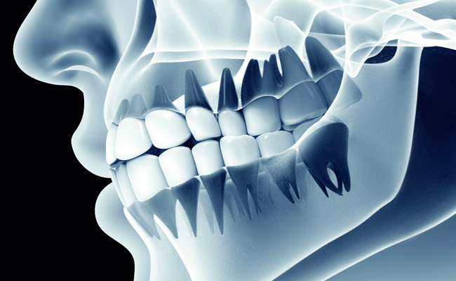Radiografía de mandíbula y dentadura